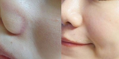 [分享]藻針療程該如何選擇適合自己的/居家萬用藻針霜心得